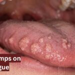 HPV Bumps on Tongue
