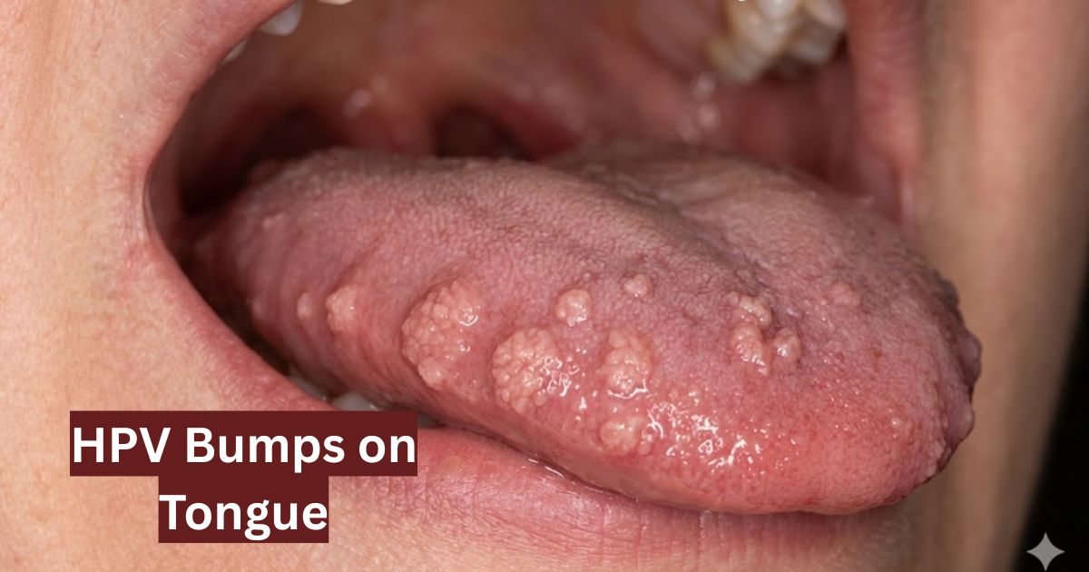 HPV Bumps on Tongue