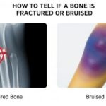 How to Tell If a Bone Is Fractured or Bruised